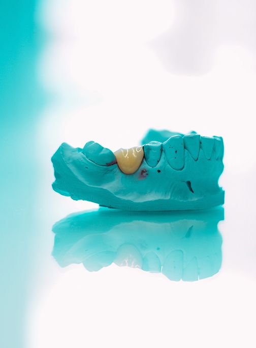 Implant-Supported Prosthesis - Prothèses sur implants - Centre Dentaire Ahuntsic
